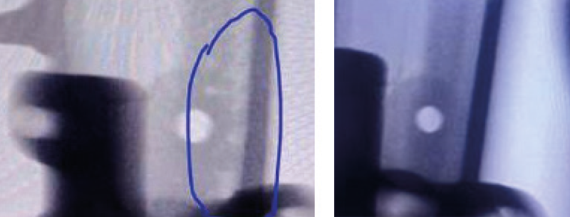 Döküm parçanın soğutucu çubuk optimizasyonu öncesi (sol) ve sonrası (sağ) X-Ray incelemesi 